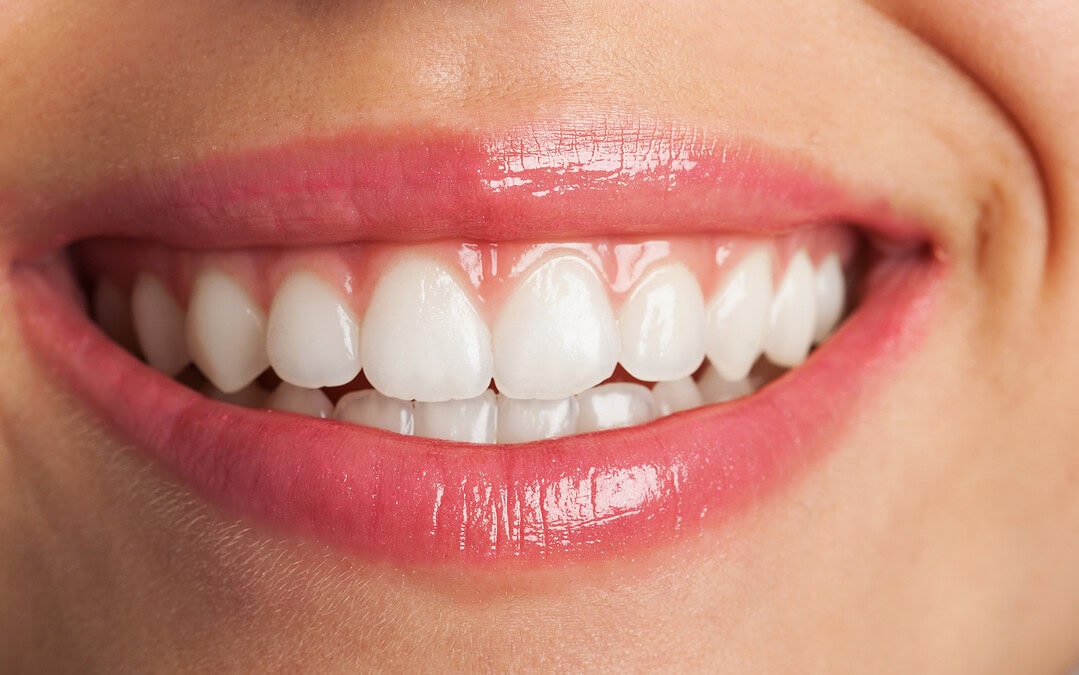 Gesunde Zähne: Neues Gel regeneriert Zahnschmelz